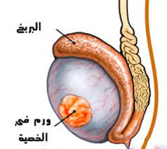 كيف يؤثر السرطان علي المريض جنسيا 